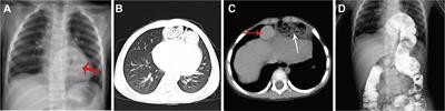 Single-site laparoscopic ligation of the hernia sac in infants with congenital Morgagni hernia